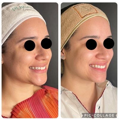 Botox_antesdepois_01.jpg