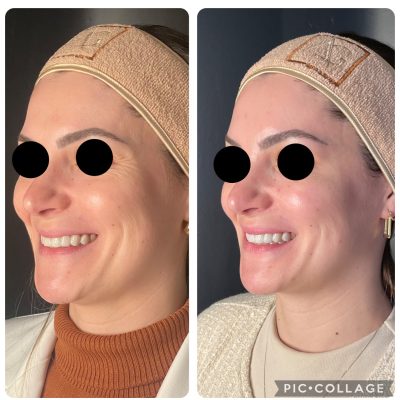 Botox_antesdepois_02.jpg