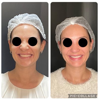 Botox_antesdepois_04.jpg