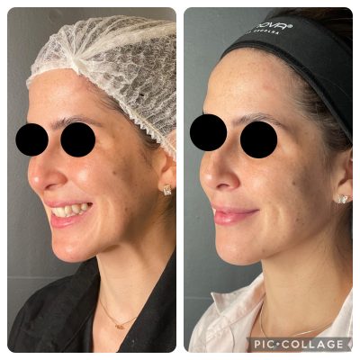 Botox_antesdepois_05.jpg