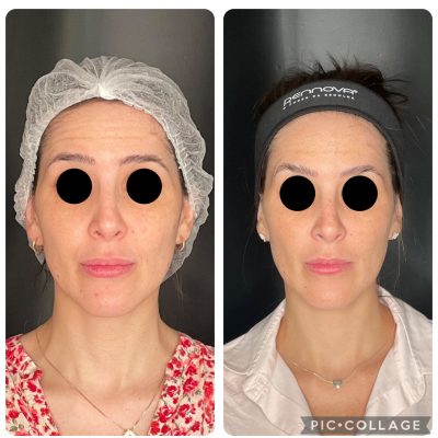 Botox_antesdepois_06.jpg