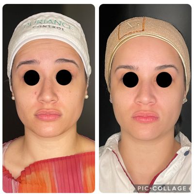 Botox_antesdepois_07.jpg
